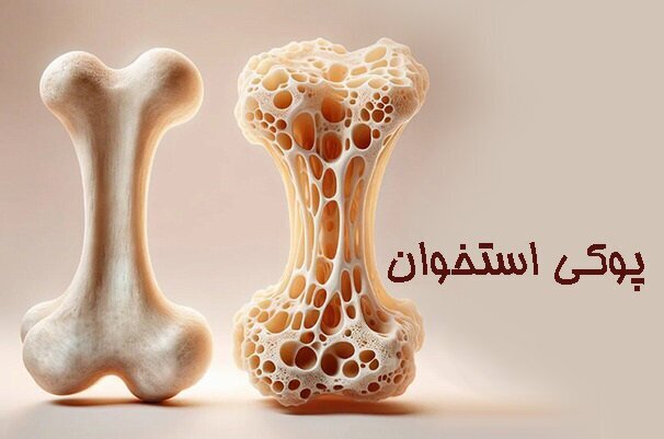 در دهه چهارم زندگی مراقب پوکی استخوان باشید